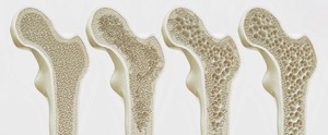Osteoporoza: 4 stadia rozrzedzenia kości.